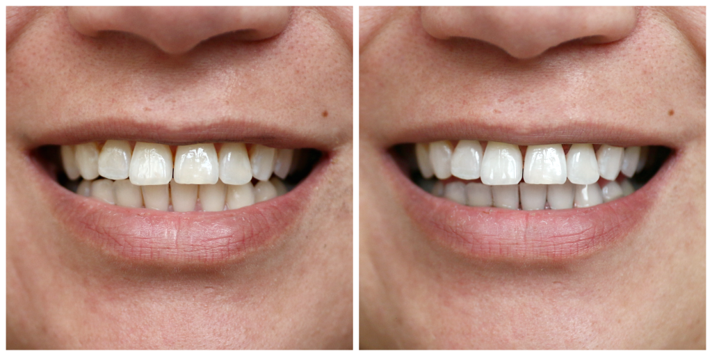 Frons overdrijving eerste Wittere tanden met houtskool, werkt dit nu echt? ⋆ Beautylab.nl