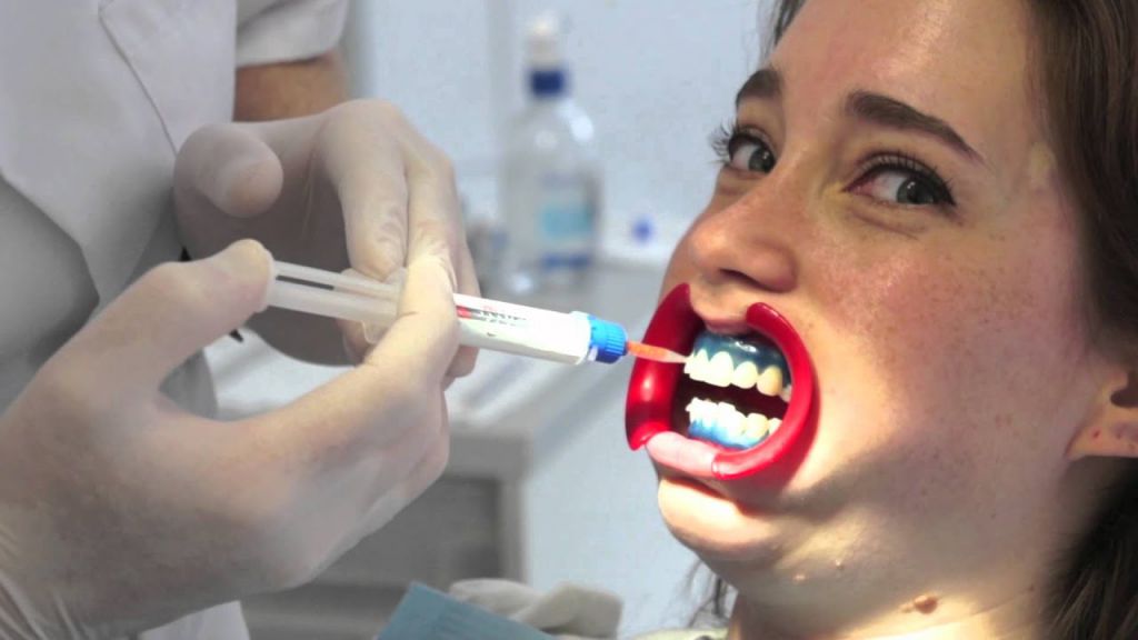 Vulgariteit Tomaat Volharding Dit gebeurt er tijdens het bleken van je tanden ⋆ Beautylab.nl
